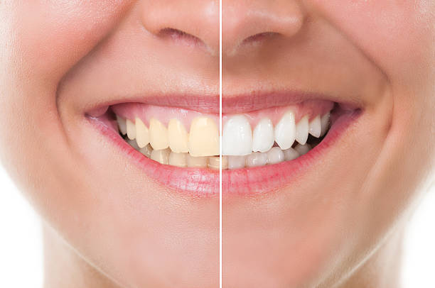 How Long Does It Take To Whiten Teeth?